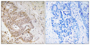ZNF592 Antibody - Immunohistochemistry analysis of paraffin-embedded human colon carcinoma tissue, using ZNF592 Antibody. The picture on the right is blocked with the synthesized peptide.