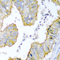 ZNF673 Antibody - Immunohistochemistry of paraffin-embedded human colon carcinoma tissue.