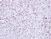 ZNF707 Antibody - IHC of paraffin-embedded H3347 xenograft using ZNF707 antibody at 1:500 dilution.