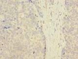 ZNF707 Antibody - Immunohistochemistry of paraffin-embedded human gastric cancer using antibody at dilution of 1:100.