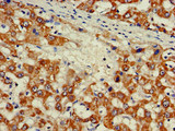 ZNF816 / ZNF816A Antibody - Immunohistochemistry of paraffin-embedded human liver cancer at dilution of 1:100