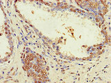 ZNF844 Antibody - Immunohistochemistry of paraffin-embedded human prostate cancer using ZNF844 Antibody at dilution of 1:100