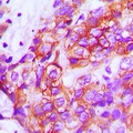 ZP1 Antibody - Immunohistochemical analysis of ZP1 staining in human breast cancer formalin fixed paraffin embedded tissue section. The section was pre-treated using heat mediated antigen retrieval with sodium citrate buffer (pH 6.0). The section was then incubated with the antibody at room temperature and detected with HRP and DAB as chromogen. The section was then counterstained with hematoxylin and mounted with DPX.