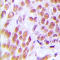 ZRANB2 / ZNF265 Antibody - Immunohistochemical analysis of ZNF265 staining in human breast cancer formalin fixed paraffin embedded tissue section. The section was pre-treated using heat mediated antigen retrieval with sodium citrate buffer (pH 6.0). The section was then incubated with the antibody at room temperature and detected with HRP and DAB as chromogen. The section was then counterstained with hematoxylin and mounted with DPX.