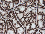 ZSCAN18 / ZNF447 Antibody - IHC of paraffin-embedded Carcinoma of Human thyroid tissue using anti-ZSCAN18 mouse monoclonal antibody. (Heat-induced epitope retrieval by 10mM citric buffer, pH6.0, 120°C for 3min).