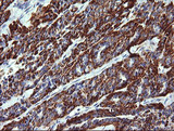 ZSCAN21 / Zipro1 Antibody - IHC of paraffin-embedded Carcinoma of Human thyroid tissue using anti-ZSCAN21 mouse monoclonal antibody.