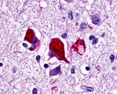 Neurofibrillary tangles stained with antibody LS-A443 to GPR78.