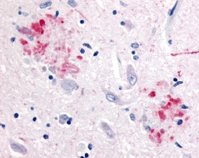 Senile plaque stained with antibody LS-C312 to Beta Amyloid Precursor protein