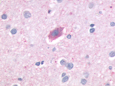 Brain, Alzheimer's neurofibrillary tangle