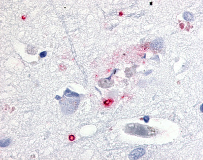 Brain, Alzheimer's, senile plaque and neuron with granulovacuolar degeneration