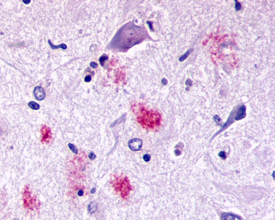 Brain, Alzheimer's disease senile plaques (positive) and neurofibrillary tangles (negative)