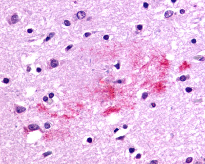 Brain, Alzheimer's disease senile plaque