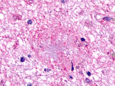 Brain, Alzheimer's disease senile plaque