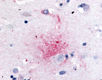Brain, Alzheimer's Disease, Senile plaque