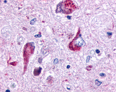 Brain, Alzheimer's disease, Neurofibrillary Tangles and Granulovacuolar Degeneration, CA1