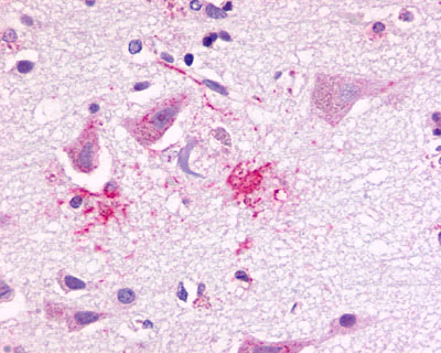 Brain, Alzheimer's, neurons and senile plaque