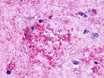 Brain, Alzheimer's disease, senile plaque