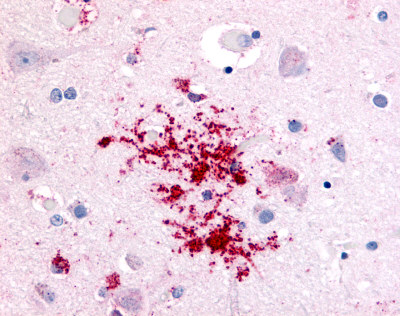 Brain, Alzheimer's disease, protoplasmic astrocytes