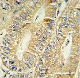15-PGDH / HPGD Antibody - HPGD Antibody IHC of formalin-fixed and paraffin-embedded human colon carcinoma followed by peroxidase-conjugated secondary antibody and DAB staining.