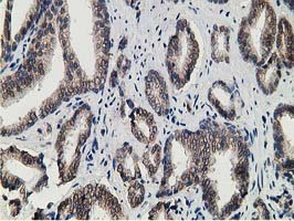 15-PGDH / HPGD Antibody - IHC of paraffin-embedded Carcinoma of Human prostate tissue using anti-HPGD mouse monoclonal antibody. (Heat-induced epitope retrieval by 10mM citric buffer, pH6.0, 100C for 10min).