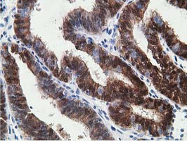 15-PGDH / HPGD Antibody - IHC of paraffin-embedded Adenocarcinoma of Human endometrium tissue using anti-HPGD mouse monoclonal antibody.