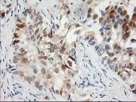 15-PGDH / HPGD Antibody - IHC of paraffin-embedded Carcinoma of Human lung tissue using anti-HPGD mouse monoclonal antibody.