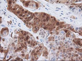 15-PGDH / HPGD Antibody - IHC of paraffin-embedded Carcinoma of Human bladder tissue using anti-HPGD mouse monoclonal antibody.