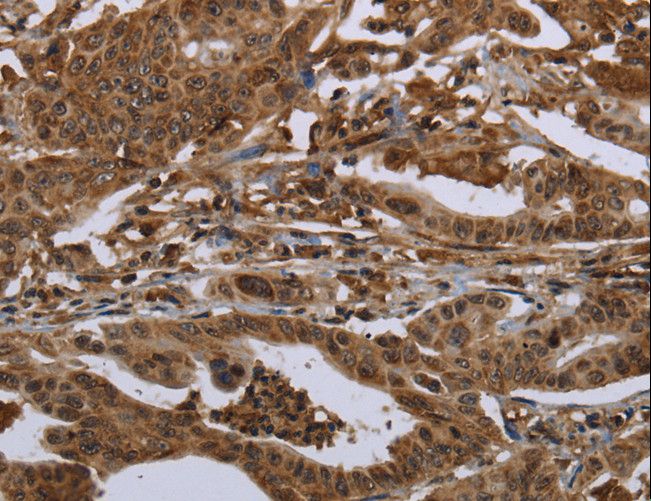 15-PGDH / HPGD Antibody - Immunohistochemistry of paraffin-embedded Human gastric cancer using HPGD Polyclonal Antibody at dilution of 1:30.