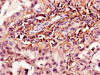 15-PGDH / HPGD Antibody - Immunohistochemistry of paraffin-embedded human lung cancer using HPGD Antibody at dilution of 1:100
