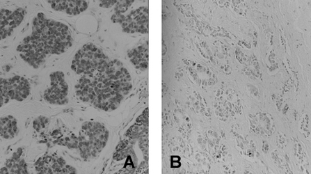 4-Amino Biphenyl DNA Antibody - 4-amino Biphenyl DNA Antibody (4C11) -  4-ABP-DNA Antibody (4C11) - Immunohistochemistry on human breast tumor tissue with high (A) and low (B) adduct levels.