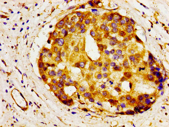 A1BG Antibody - Immunohistochemistry image of paraffin-embedded human breast cancer at a dilution of 1:100