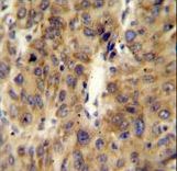A1CF / ACF Antibody - ACF Antibody immunohistochemistry of formalin-fixed and paraffin-embedded human hepatocarcinoma followed by peroxidase-conjugated secondary antibody and DAB staining.