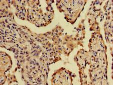 A2ML1 Antibody - Immunohistochemistry of paraffin-embedded human lung cancer at dilution of 1:100
