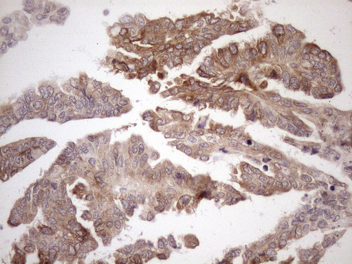 AAAS / Adracalin Antibody - Immunohistochemical staining of paraffin-embedded Adenocarcinoma of Human ovary tissue using anti-AAAS mouse monoclonal antibody. (Heat-induced epitope retrieval by 1mM EDTA in 10mM Tris buffer. (pH8.5) at 120°C for 3 min. (1:150)