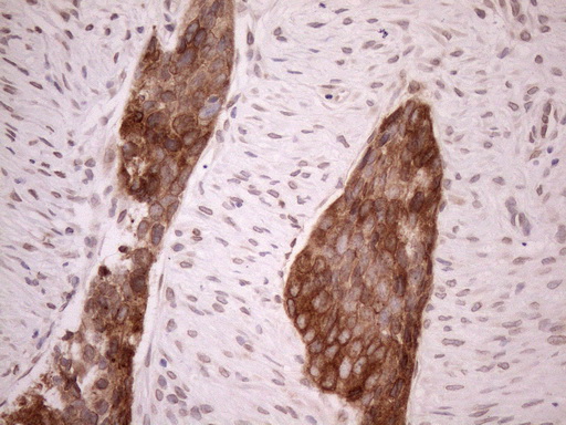 AAAS / Adracalin Antibody - Immunohistochemical staining of paraffin-embedded Adenocarcinoma of Human endometrium tissue using anti-AAAS mouse monoclonal antibody. (Heat-induced epitope retrieval by 1mM EDTA in 10mM Tris buffer. (pH8.5) at 120°C for 3 min. (1:150)