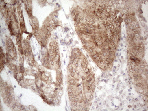 AAAS / Adracalin Antibody - Immunohistochemical staining of paraffin-embedded Adenocarcinoma of Human colon tissue using anti-AAAS mouse monoclonal antibody. (Heat-induced epitope retrieval by 1mM EDTA in 10mM Tris buffer. (pH8.5) at 120°C for 3 min. (1:150)