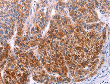 AADAC Antibody - Immunohistochemistry of paraffin-embedded Human liver cancer using AADAC Polyclonal Antibody at dilution of 1:30.