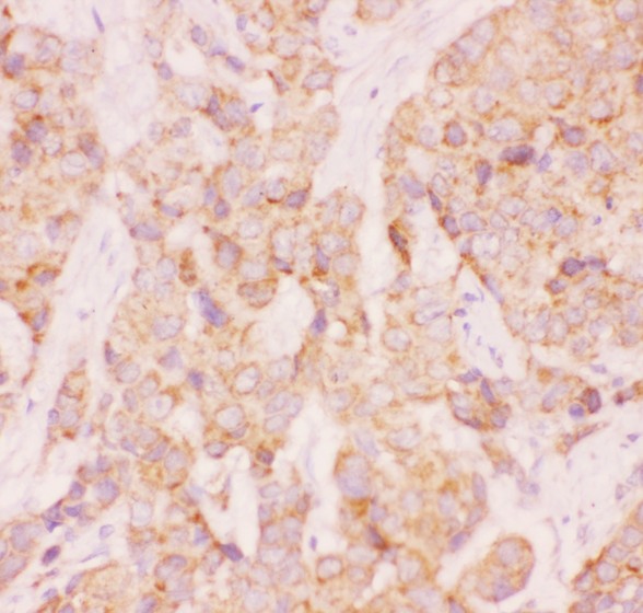 AAMP Antibody - AAMP antibody IHC-paraffin: Human Mammary Cancer Tissue.