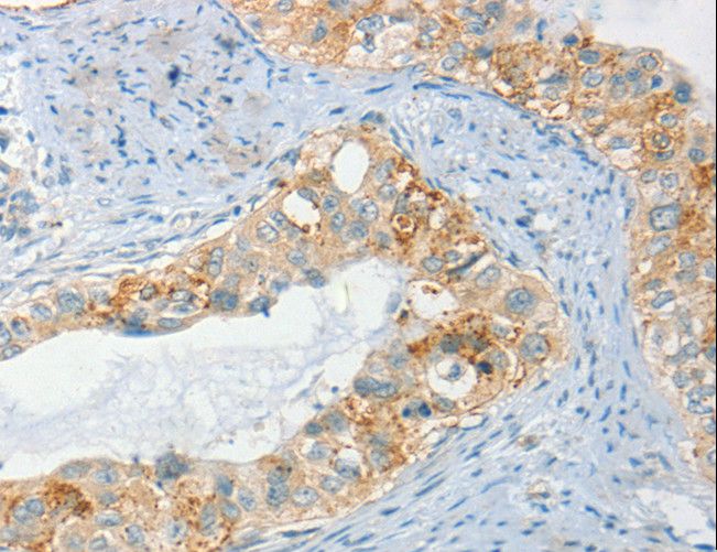 AANAT Antibody - Immunohistochemistry of paraffin-embedded Human cervical cancer using AANAT Polyclonal Antibody at dilution of 1:40.