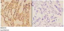 AANAT Antibody - Immunohistochemistry (IHC) analysis of AANAT antibody in paraffin-embedded human breast carcinoma tissue at 1:50, showing cytoplasmic strong positive staining. Negative control (the right) using PBS instead of primary antibody. Secondary antibody is Goat Anti-Rabbit IgG.