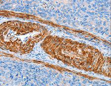 AARS Antibody - Immunohistochemistry of paraffin-embedded Human cervical cancer using AARS Polyclonal Antibody at dilution of 1:60.