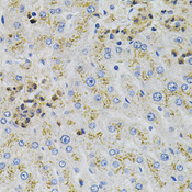 AARS Antibody - Immunohistochemistry of paraffin-embedded human liver injury tissue.