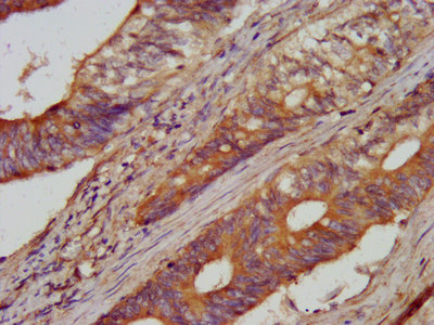 AARS Antibody - Immunohistochemistry image at a dilution of 1:100 and staining in paraffin-embedded human colon cancer performed on a Leica BondTM system. After dewaxing and hydration, antigen retrieval was mediated by high pressure in a citrate buffer (pH 6.0) . Section was blocked with 10% normal goat serum 30min at RT. Then primary antibody (1% BSA) was incubated at 4 °C overnight. The primary is detected by a biotinylated secondary antibody and visualized using an HRP conjugated SP system.