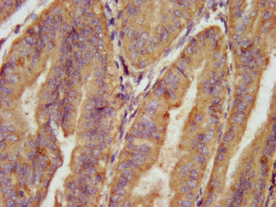 AARS Antibody - Immunohistochemistry image at a dilution of 1:100 and staining in paraffin-embedded human endometrial cancer performed on a Leica BondTM system. After dewaxing and hydration, antigen retrieval was mediated by high pressure in a citrate buffer (pH 6.0) . Section was blocked with 10% normal goat serum 30min at RT. Then primary antibody (1% BSA) was incubated at 4 °C overnight. The primary is detected by a biotinylated secondary antibody and visualized using an HRP conjugated SP system.