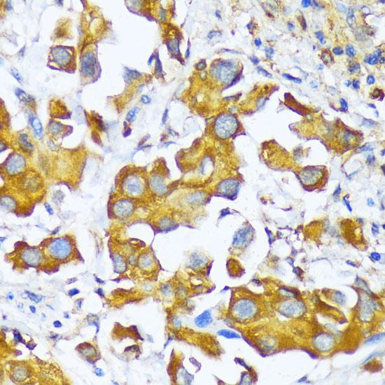 AARS Antibody - Immunohistochemistry of paraffin-embedded Human lung cancer using AARS Polyclonal Antibody at dilution of 1:100 (40x lens).