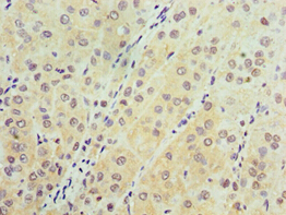 AARS2 Antibody - Immunohistochemistry of paraffin-embedded human liver cancer using antibody at 1:100 dilution.