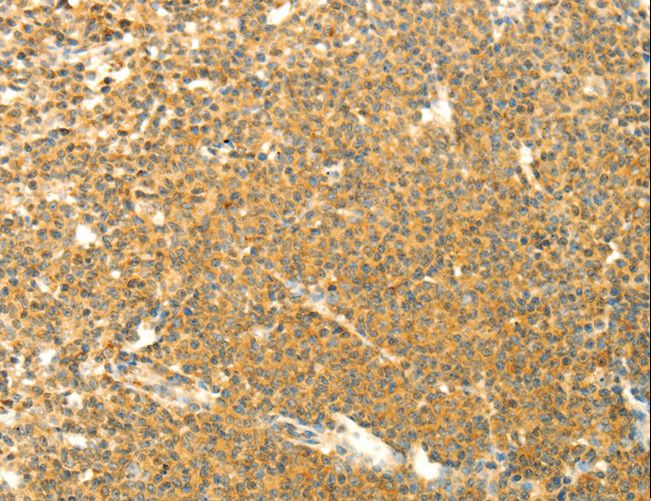 AARS2 Antibody - Immunohistochemistry of paraffin-embedded Human lymphoma using AARS2 Polyclonal Antibody at dilution of 1:40.