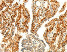 AARS2 Antibody - Immunohistochemistry of paraffin-embedded Human thyroid cancer using AARS2 Polyclonal Antibody at dilution of 1:80.