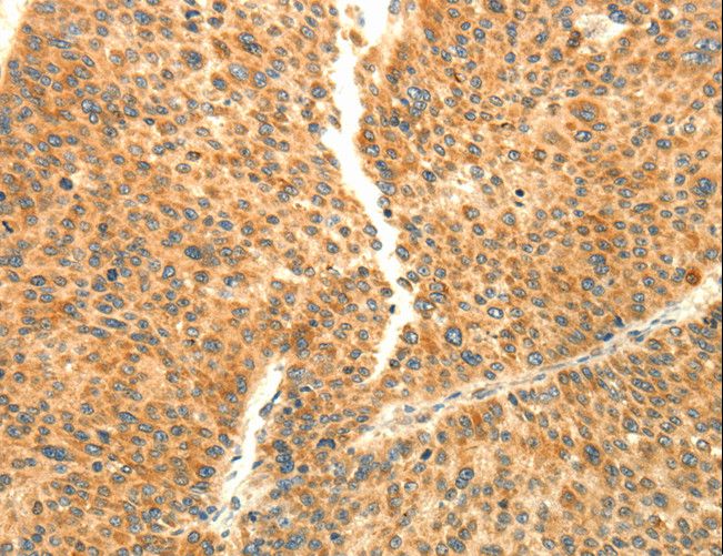 AARS2 Antibody - Immunohistochemistry of paraffin-embedded Human liver cancer using AARS2 Polyclonal Antibody at dilution of 1:80.