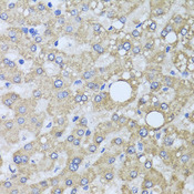 AARS2 Antibody - Immunohistochemistry of paraffin-embedded human liver injury tissue.